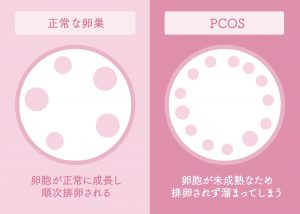 多嚢胞性卵巣症候群（PCOS）とは？