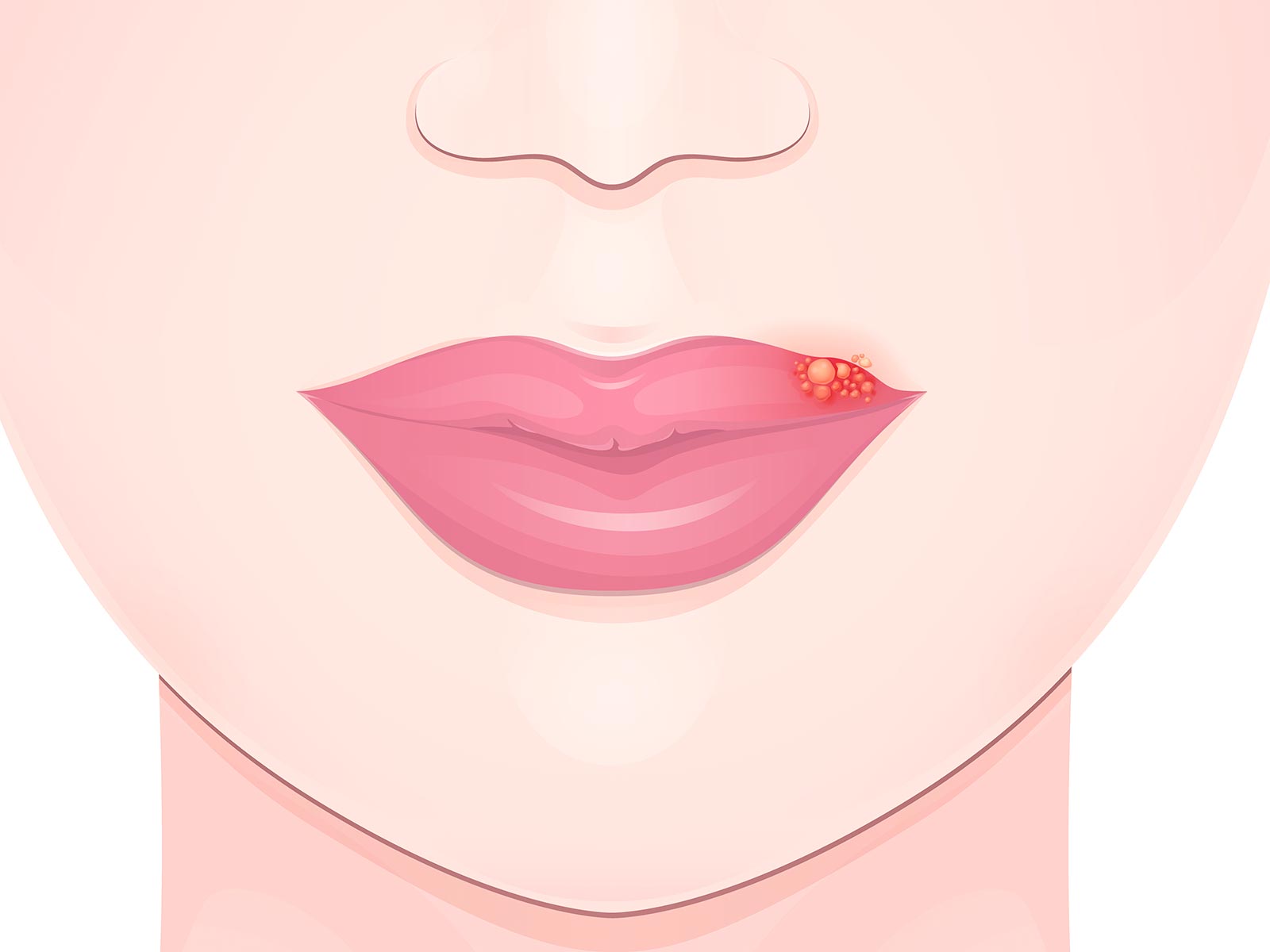 口唇ヘルペスの症状を知り早期の対応を